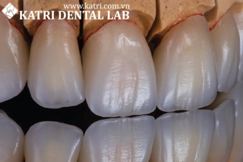 RĂNG SỨ CERAMILL ZI