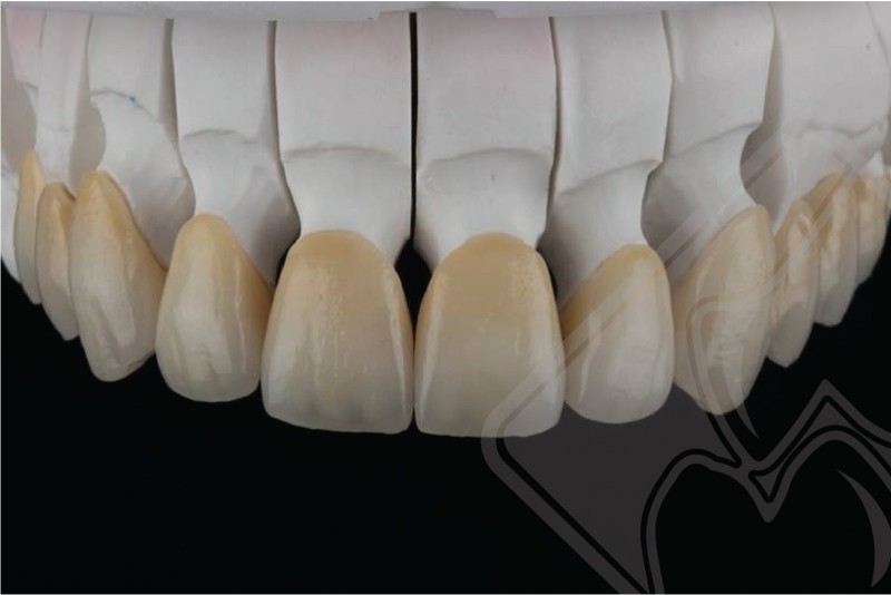 RĂNG SỨ NACERA PEARL 16+2